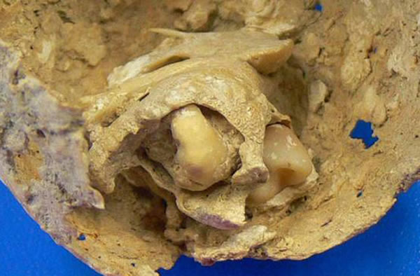 A close-up of an odd tumor embedded with teeth hidden in the pelvis of an ancien