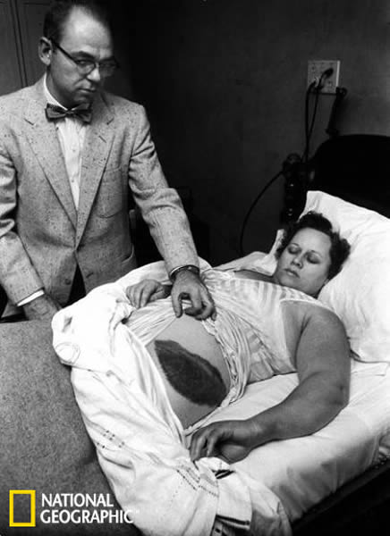 1954年,医生穆迪·雅各布(Moody Jacobs)展示他的病人——安·霍吉斯女士身上的一个大伤口,这是被陨石擦伤导致的