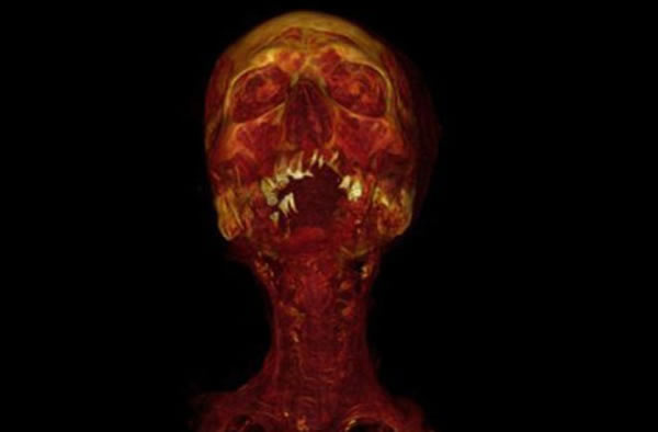 This CT with 3D volume rendering shows Hatiay, a mummified male Egyptian scribe