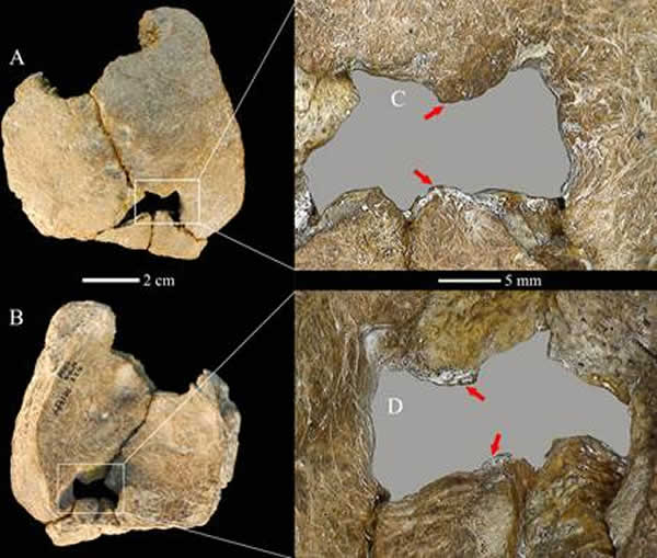 图1. 许家窑11号个体罕见的先天巨顶孔缺陷,外侧面观(A,C)和内侧面观(B, D),箭头示光滑的穿孔边缘. (吴秀杰供图)