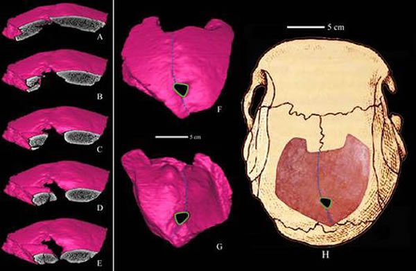 图2. CT扫描3D复原许家窑11号标本, A-E:冠状面连续切片通过巨顶孔,示外板光滑转向内板,无板障层暴露或愈合迹象;F-G:巨顶孔复原.;H:巨顶孔在头骨