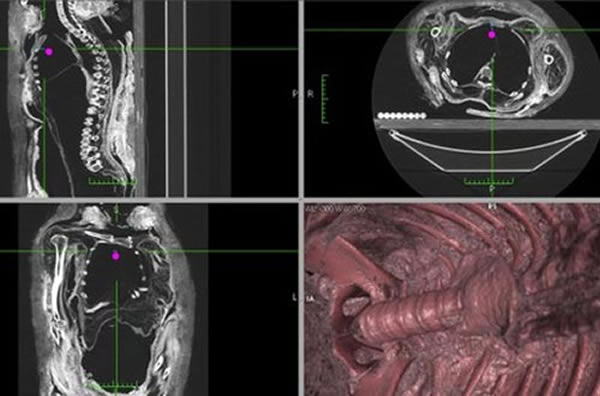 �о���Ա�Լ��ô�ʼҰ����Բ����һ��ľ����ʬ��ո���ǻ������CT��Ƭ��3D�ṹ�ؽ�