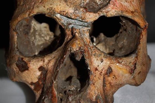 This skull of an adult male shows traces of a broken nose and a blunt-force inju