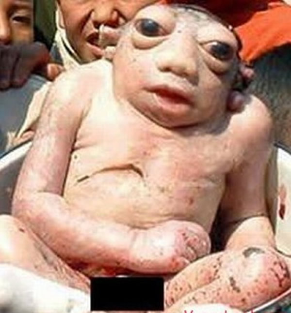 尼泊尔的“外星婴儿”