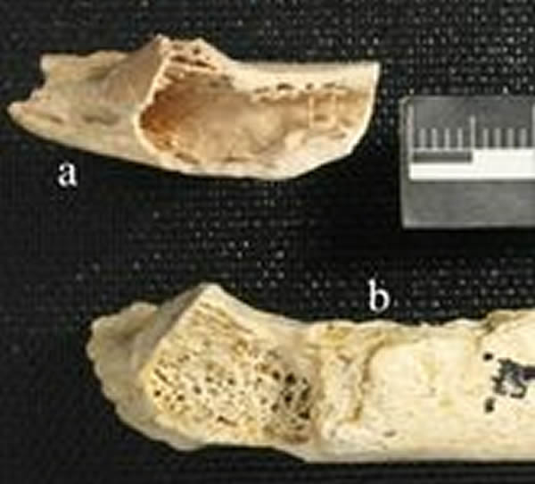 A Neanderthal bone fragment shows a cancerous tumor. Image courtesy Monge J., Kr