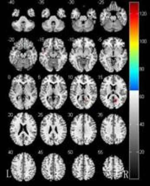 帕金森病伴痴呆患者较不伴痴呆患者大脑灰质体积显著减少的区域
