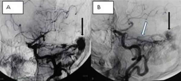 61�����Ի�����������Ӳ��Ĥ������������ǰ��A����10���B����Ѫ����Ӱ���׼�ͷʾ�Ҳ�С���϶���������һ������Ѫ������10��д������Ӳ��Ĥ�����������ڼ�ͷ