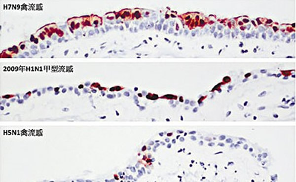 图片显示人类支气管上皮组织,棕色部分显示被病毒感染的细胞,蓝色部分显示非感染的细胞。研究指H7N9病毒与2009年的甲型流感(H1N1)病毒相似。