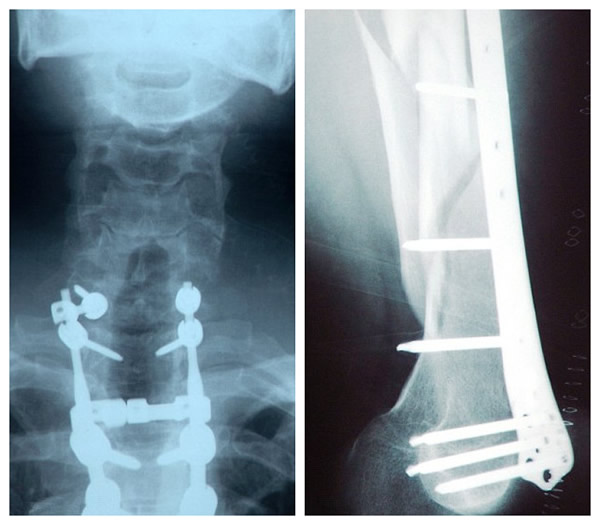 加拿大四肢瘫痪男子的极限跳伞运动