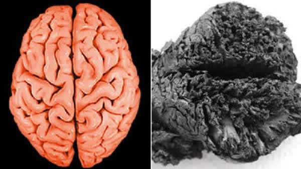 完好的人脑和已保存4000年的人脑对比图
