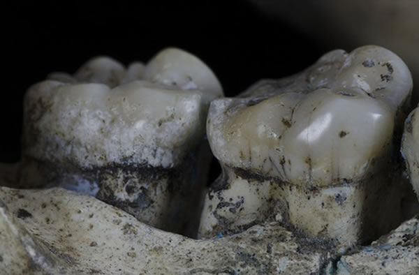 This ancient hominid jaw has marks suggesting it experienced toothpicking.