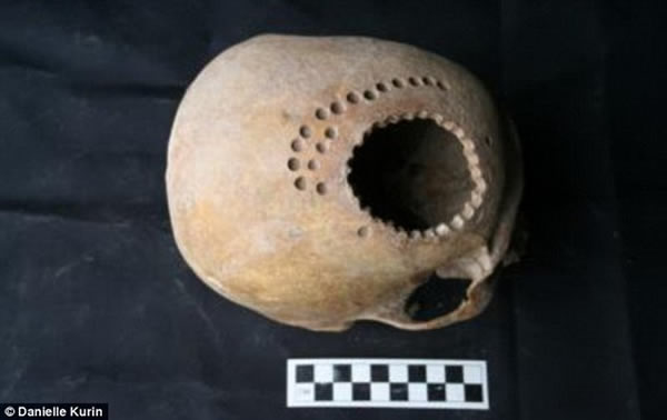最新考古研究发现，1000年前秘鲁医生能够操作头颅手术，图中是在患者头骨上钻了数十个小洞