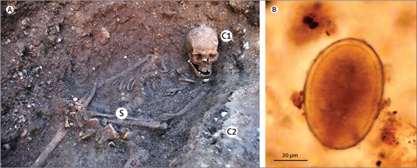 理查德三世曾感染蛔虫