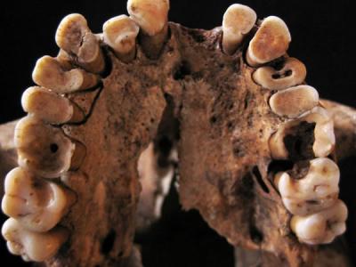 摩洛哥洞穴发现狩猎采集者人群牙齿腐蚀情况