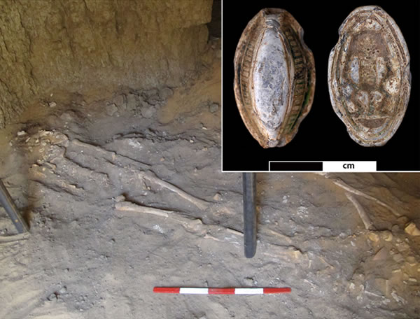 苏丹发现一具距今3200年的癌症患者的骨骼