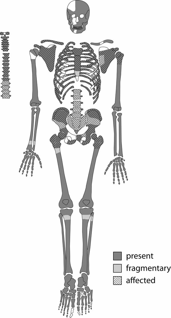 苏丹发现一具距今3200年的癌症患者的骨骼