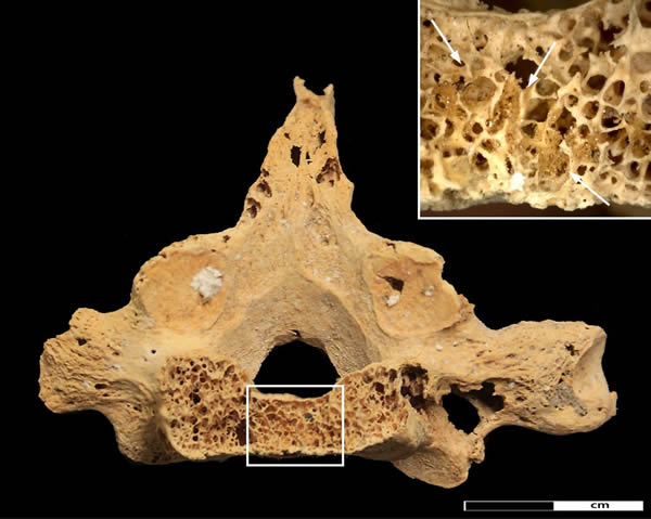 苏丹发现一具距今3200年的癌症患者的骨骼