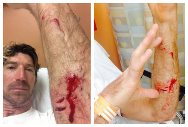 美国冲浪者遭鲨鱼袭击留20多处齿痕