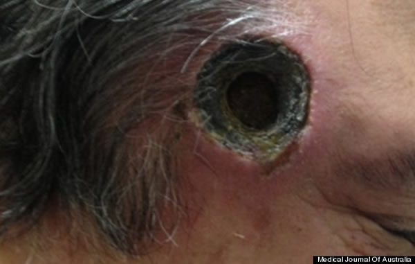 澳洲男子罹患皮肤癌听信偏方使用“黑药膏”导致头部出现恐怖大窟窿