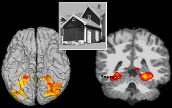 大脑深部刺激会引发幻觉