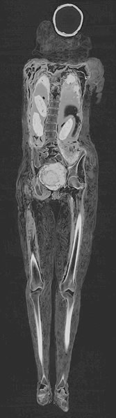 由于医院用的电脑断层扫描仪,这个木乃伊的性别最终得到确认。实际上,死者是名男子。