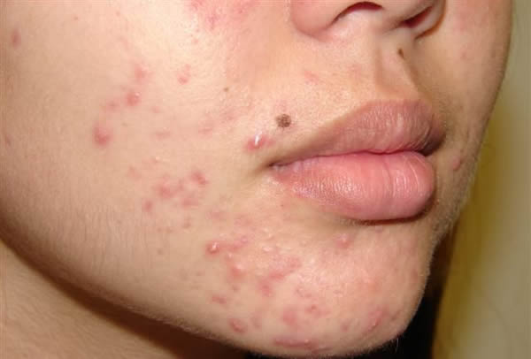 美国FDA警告消费者治疗暗疮药物可能有潜在致命过敏反应