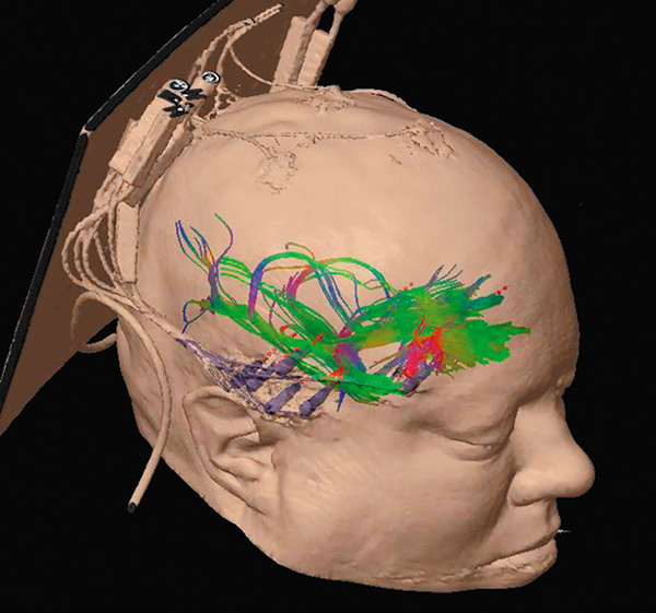 在霍金斯下一次癫痫发作时，电极就会精确找到发作来源，让神经外科医生知道该移除哪一块大脑组织。这种电极也提供了难得的机会，让科学家得以观察正常运作的神经元，因而发