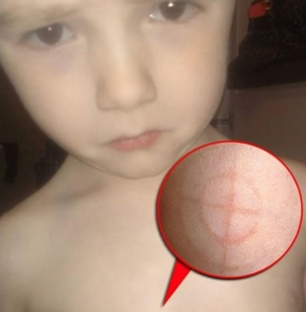 英国4岁男童胸口突然出现不明神秘“魔鬼符号”红印