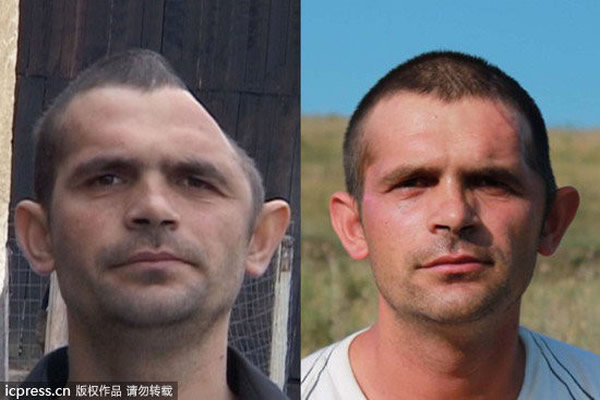 俄罗斯“半脑人”修复头盖骨