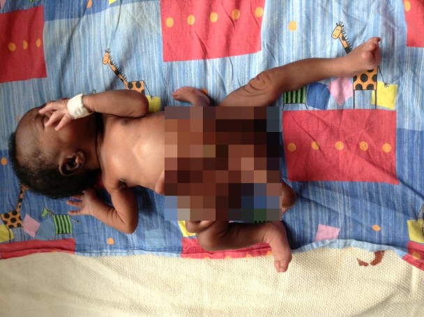 穆基沙身上长着没完全发育的孖生胎儿