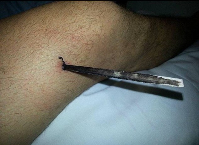 尖刺刺中贾米森的右腿