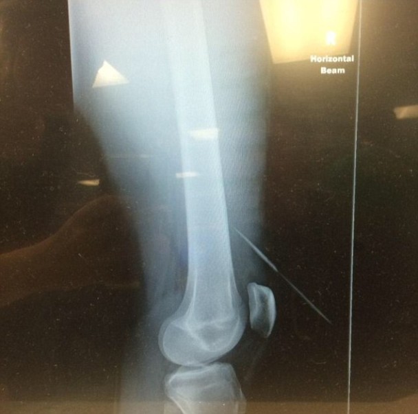 从X光片可见,尖刺仅仅避过贾米森的骨头位置。