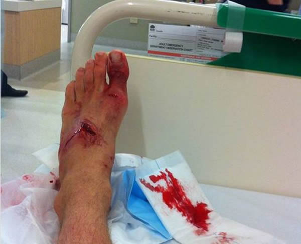 澳洲男子冲浪意外踩到一条鲨鱼的头被咬脚 猛踢保命