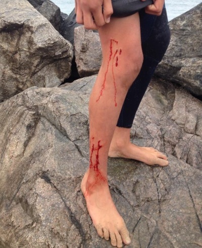 澳洲少年海边冲浪被鲨鱼咬出8个洞 淡定骑2公里车回家吃早餐