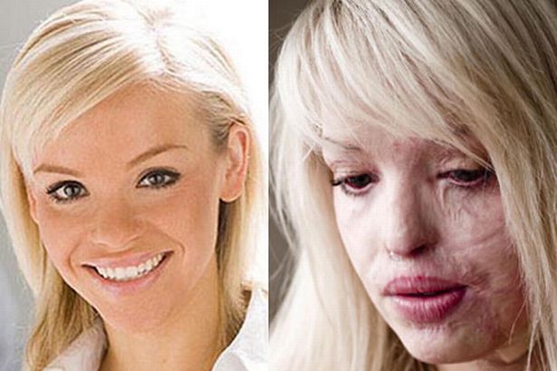 派珀被泼酸毁容,但仍积极面对人生。