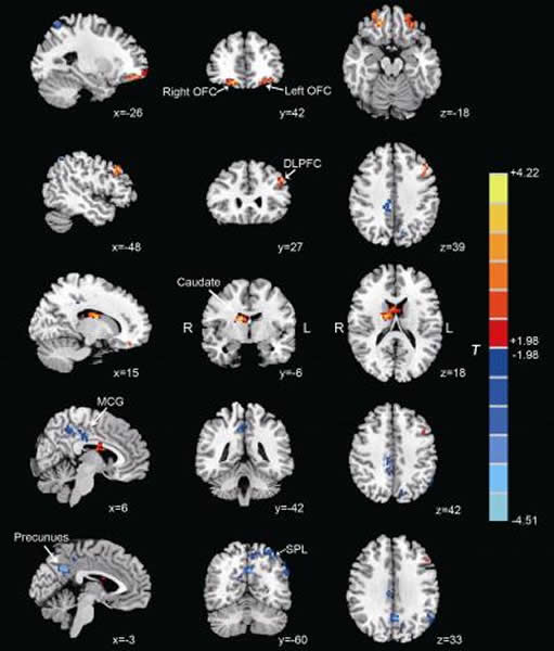 ���Ƕ��ػع�Ľ��(P< 0.05, AlphaSim corrected). ůɫ����ʾ���������, ��ɫ����ʾ���������. R��ʾ�����Ұ���, ��L��