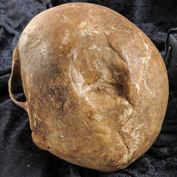 从头骨骨折中幸存下来的古丹麦人死亡风险是那些没有受伤的同伴的6.2倍