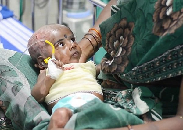 拉杰斯瓦丽称其儿子拉胡尔(图)前年出生后,先后出现4次自燃现象。