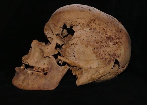 考古学家在该具有4千年历史的女性骸骨中,发现乳癌病变迹象。