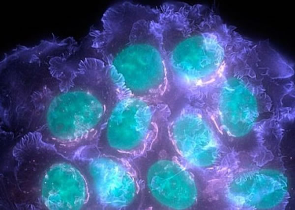 乳癌细胞会改变骨头结构