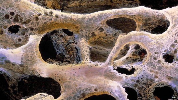 LOX会令骨头出现一个个洞,方便癌细胞依附生长。