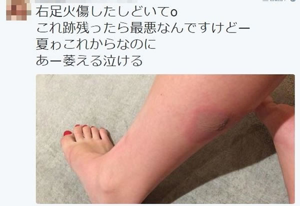 日本女网友PO灵异照“鬼手抓脚” 4天后小腿出现诡异烧伤