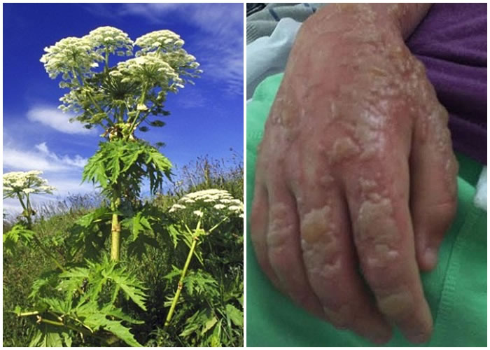 有男童的手灼伤情况严重;左图为有毒植物大型猪草。