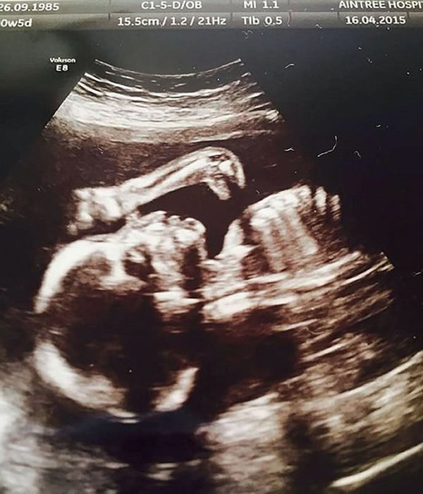 英国孕妇B超扫描图像惊现《侏罗纪公园》电影