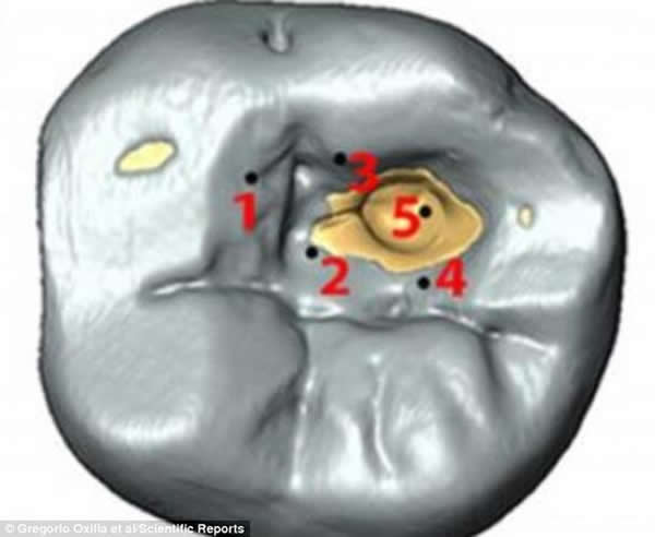 ʷǰ��ҽ��1.4����ǰ���ݻ�ʯ�Ϸ����������������ĺۼ�