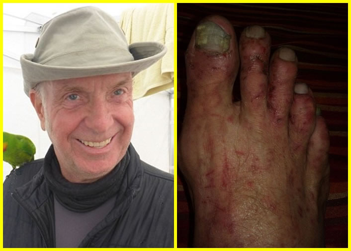 凯伊斯当日赤足在丛林寻觅出路,导致双脚伤痕累累。