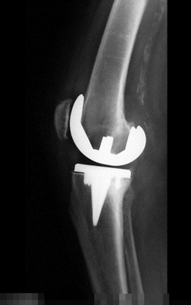 医生指妇人口腔的细菌随血液流到其假膝盖骨,导致关节受感染。