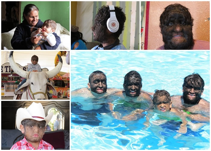 阿塞韦斯(右下图左)与家族成员,患有多毛症。