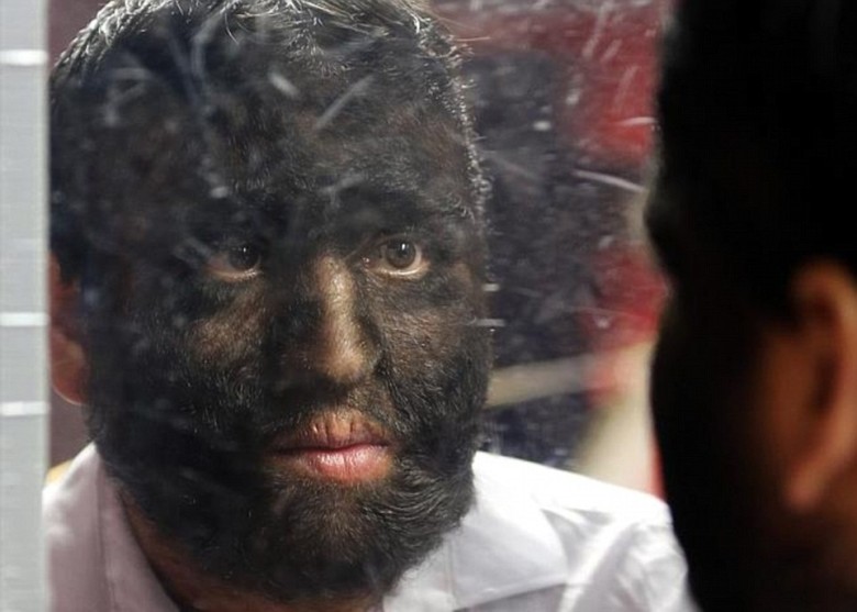 阿塞韦斯因体毛多,被看中在马戏团中扮演狼人。