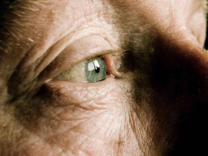 复合“溶化”的蛋白质团块导致白内障